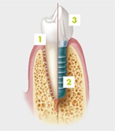 implant dentaire - dentiste allauch près de marseille