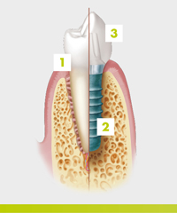 patients-what-is-a-dental-implant
